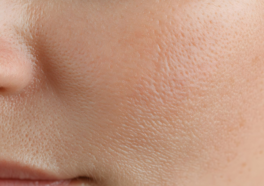 Pourquoi le froid fragilise la peau en hiver ?